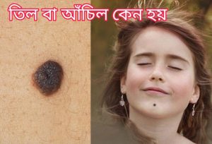 তিল বা আঁচিল কেন হয়? আঁচিল কি শরীরের জন্যে ক্ষতিকর?