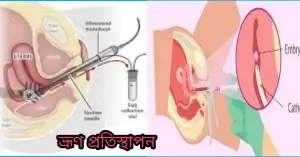জরায়ুতে ভ্রূণ সংযুক্ত করা