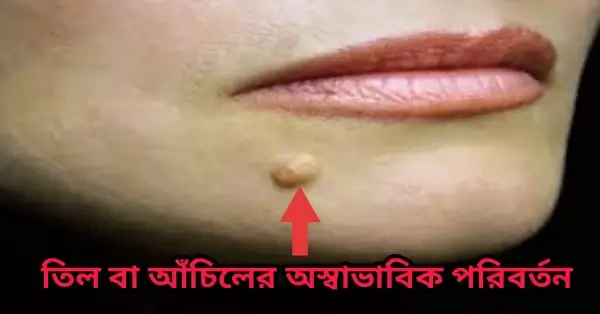 ক্যান্সারের লক্ষণ কী? ক্যান্সারের ২৫ টি লক্ষণ দেখে নিন# তিল বা আঁচিলের অস্বাভাবিক পরিবর্তন