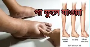 পা ফুলে যাওয়া