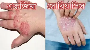 একজিমা ও সোরিয়াসিস এর পার্থক্য