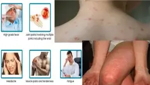 চিকুনগুনিয়া রোগের লক্ষণ