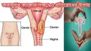 জরায়ুমুখ ক্যান্সার লক্ষণ ও প্রতিরোধের উপায়!
