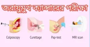 জরায়ুমুখ ক্যান্সারের পরীক্ষা