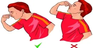 নাক দিয়ে রক্ত-পরার প্রাথমিক চিকিৎসা