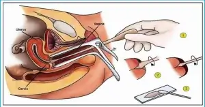 প্যাপ স্মেয়ার টেস্ট