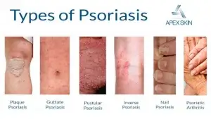 সোরিয়াসিস এর প্রকারভেদ