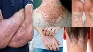 সোরিয়াসিস ছবি