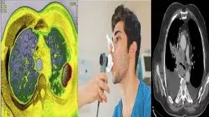 এমফাইসিমা কী? এমফাইসিমার কারণ,লক্ষণ,চিকিৎসা ও প্রতিরোধ! এমফাইসিমা পরীক্ষা