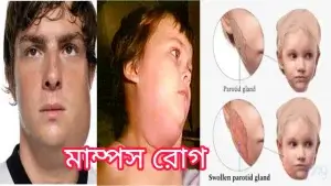মাম্পস রোগ কী?মাম্পস রোগের কারণ, লক্ষণ ও চিকিৎসা! মাম্পস রোগ কী?মাম্পস রোগের কারণ, লক্ষণ ও চিকিৎসা!