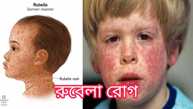 রুবেলা রোগ কী?রুবেলার কারণ,লক্ষণ,চিকিৎসা ও প্রতিরোধ! রুবেলা রোগ কী?রুবেলার কারণ,লক্ষণ,চিকিৎসা ও প্রতিরোধ!